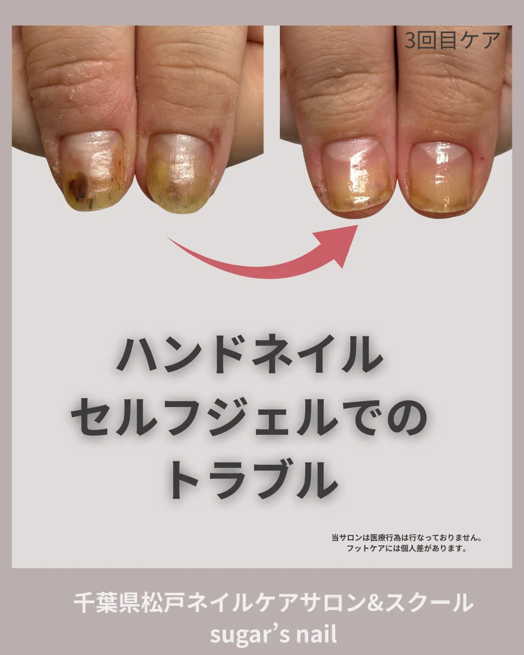 松戸市北小金の爪ケアサロン_自爪の剥離