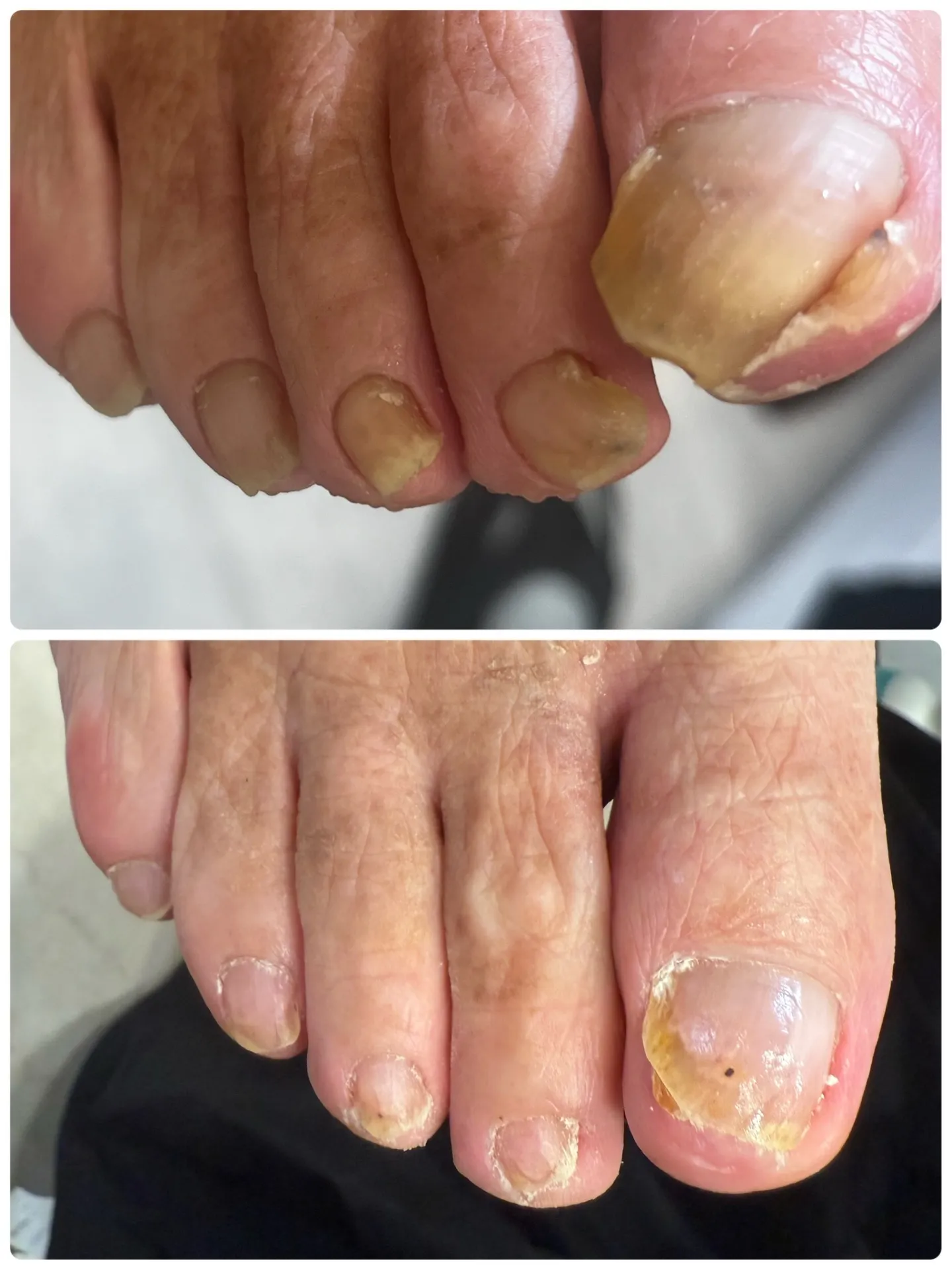 高齢の方の足の爪切り