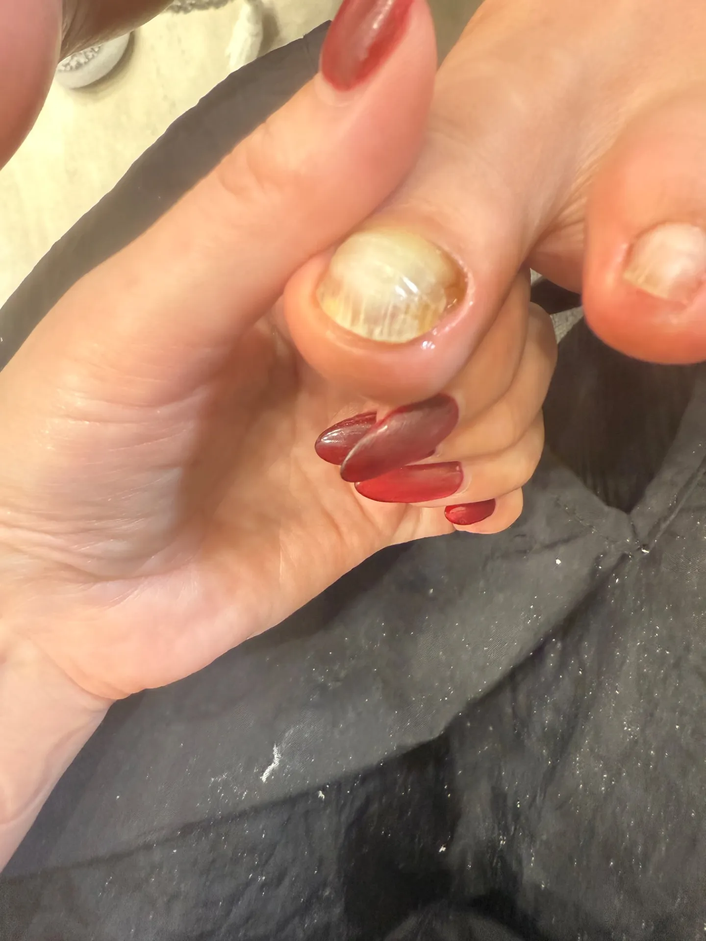 甘皮の横に角質がたまって爪が圧迫されるトラブル！実は“隣の指”が原因かも？