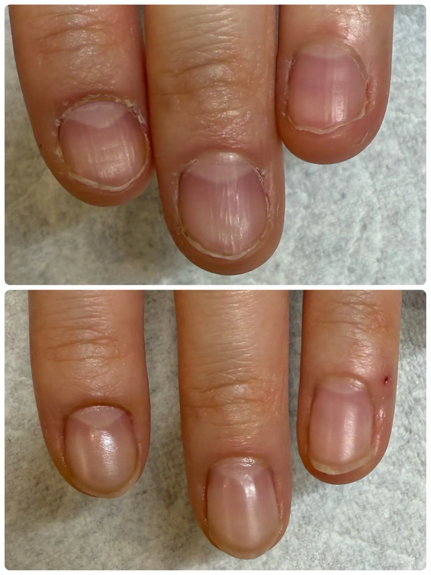 深爪ケア2ヶ月施術例