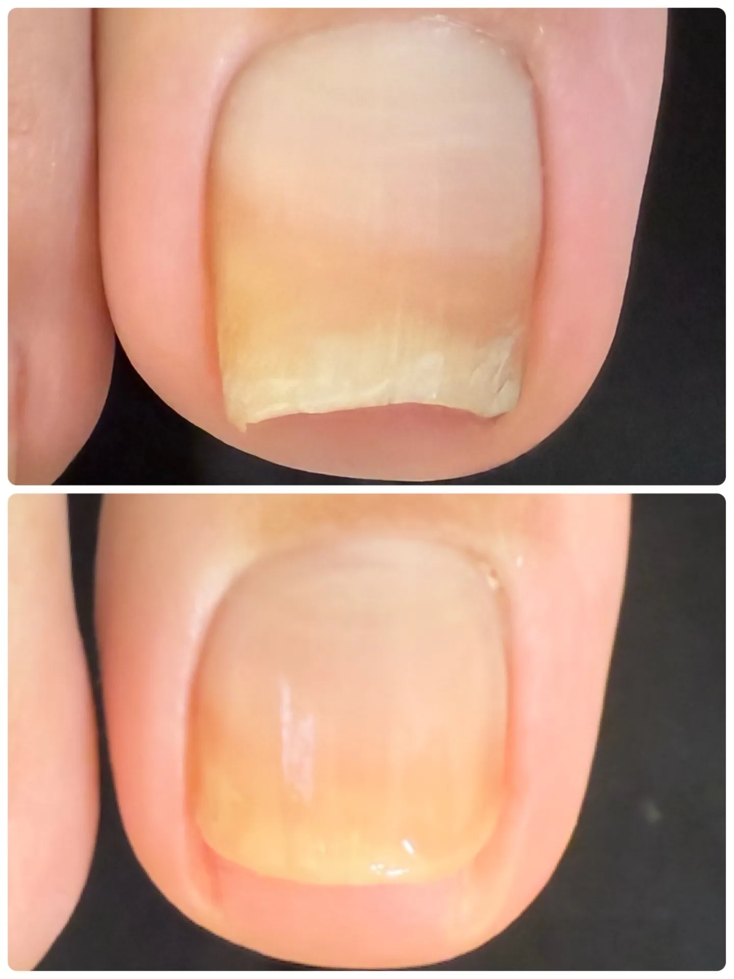 フットケアbefore after